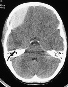 extradural-haematoma
