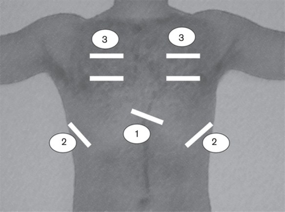 Imaging sites for rapid assessment of lung using ultrasound in dyspneic patients in prehospital setting