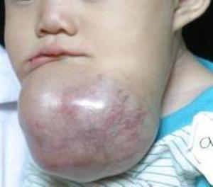 What 'rules' would you generate for intubating this child?