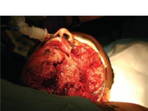 Wound from helicopter rotor blade, with Quikclot applied